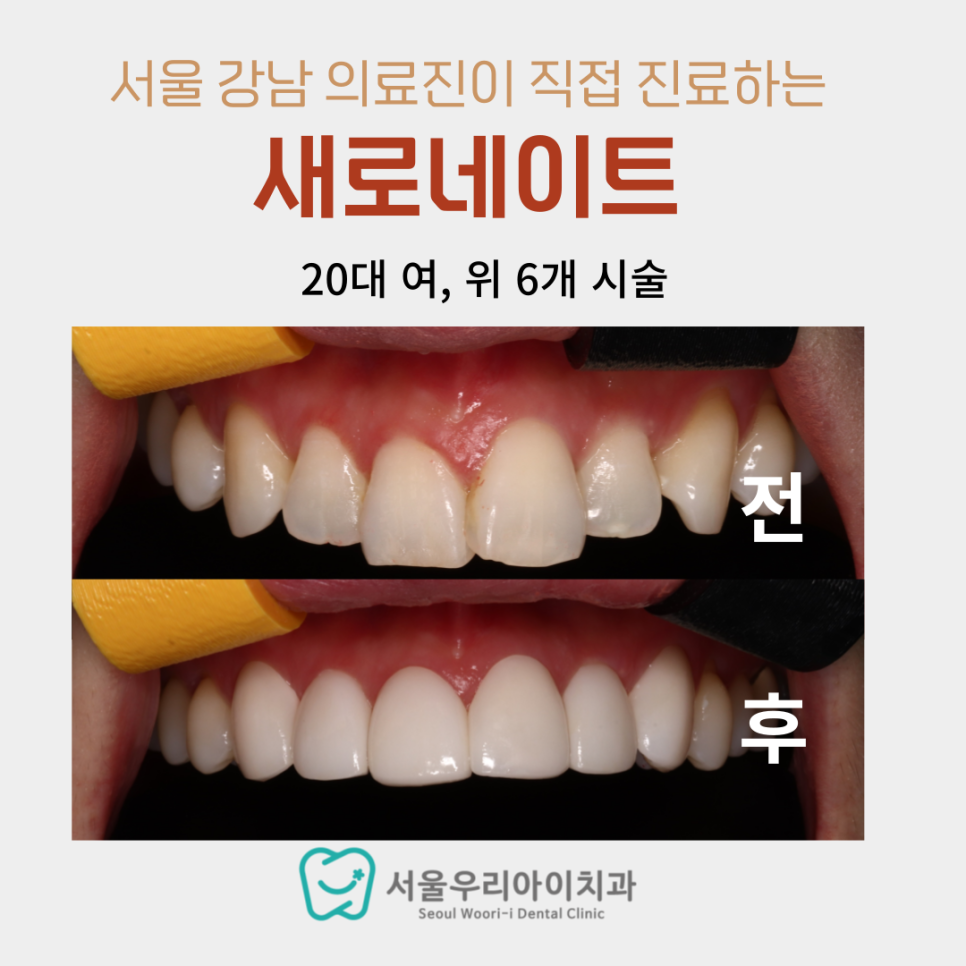 광주 앞니 급속교정 어디가 잘하나요?