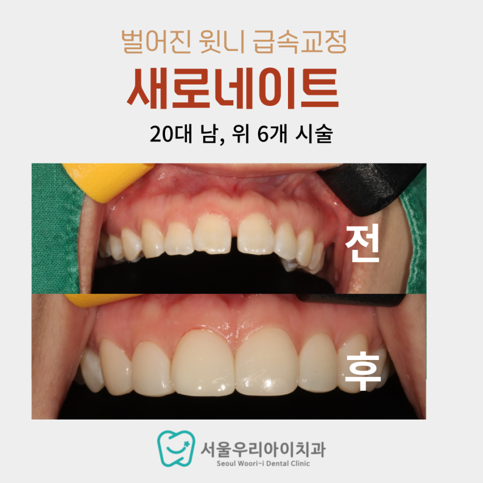 광주에서 부분 치아교정을 급속으로 해결하는 방법 필독!