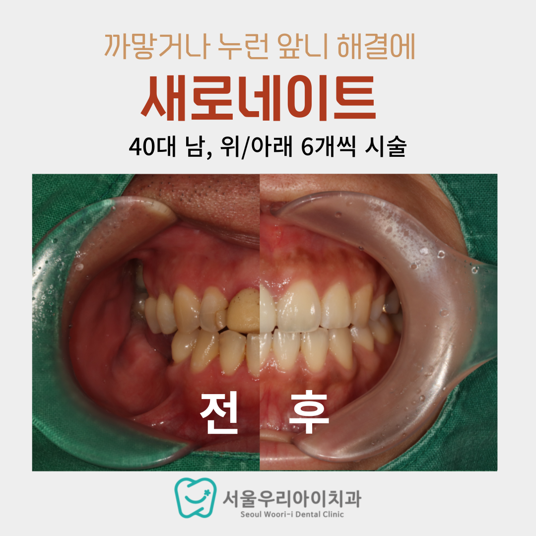 광주에서 까맣고 누런 앞니를 해결해줄 수 있는 라미네이트 치과를...