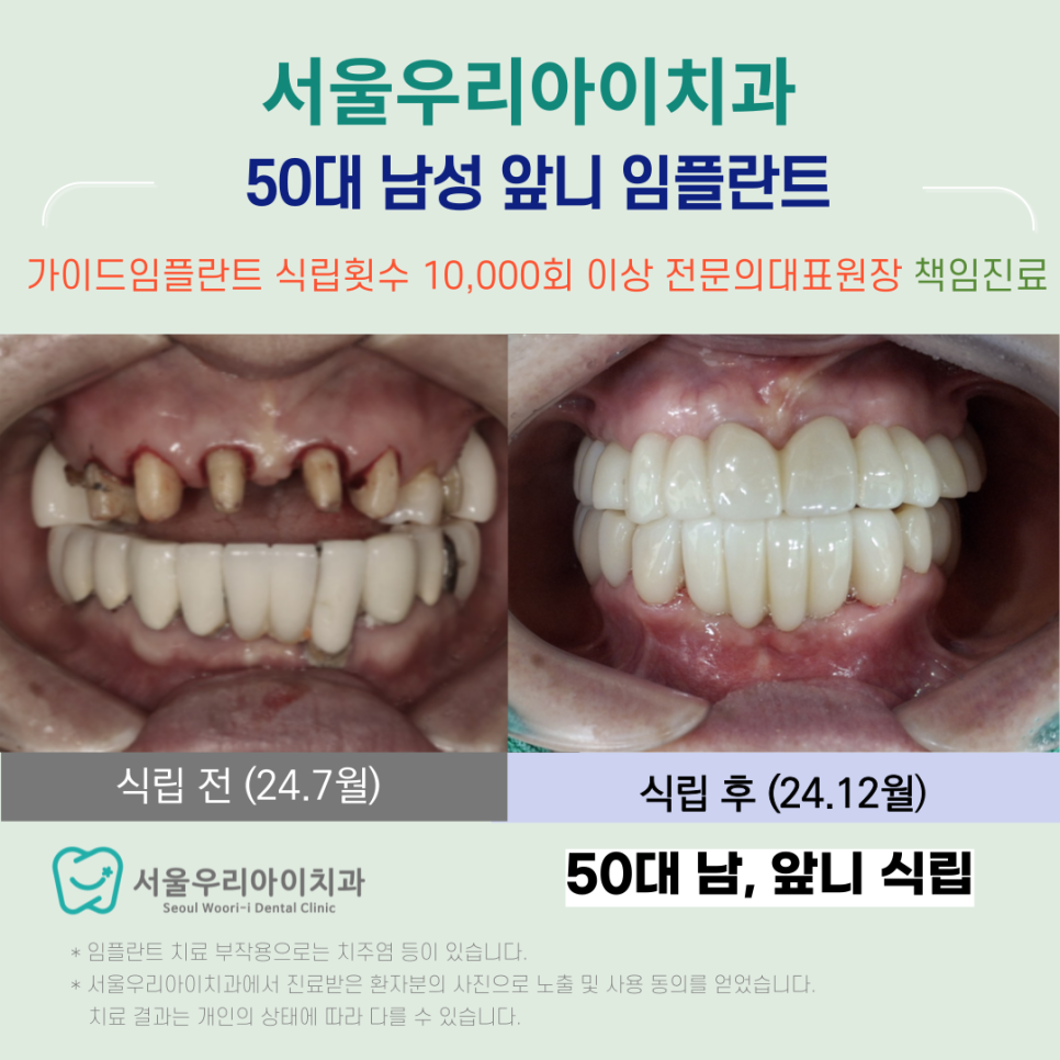 광산구에서 앞니 임플란트 잘하는 치과는?