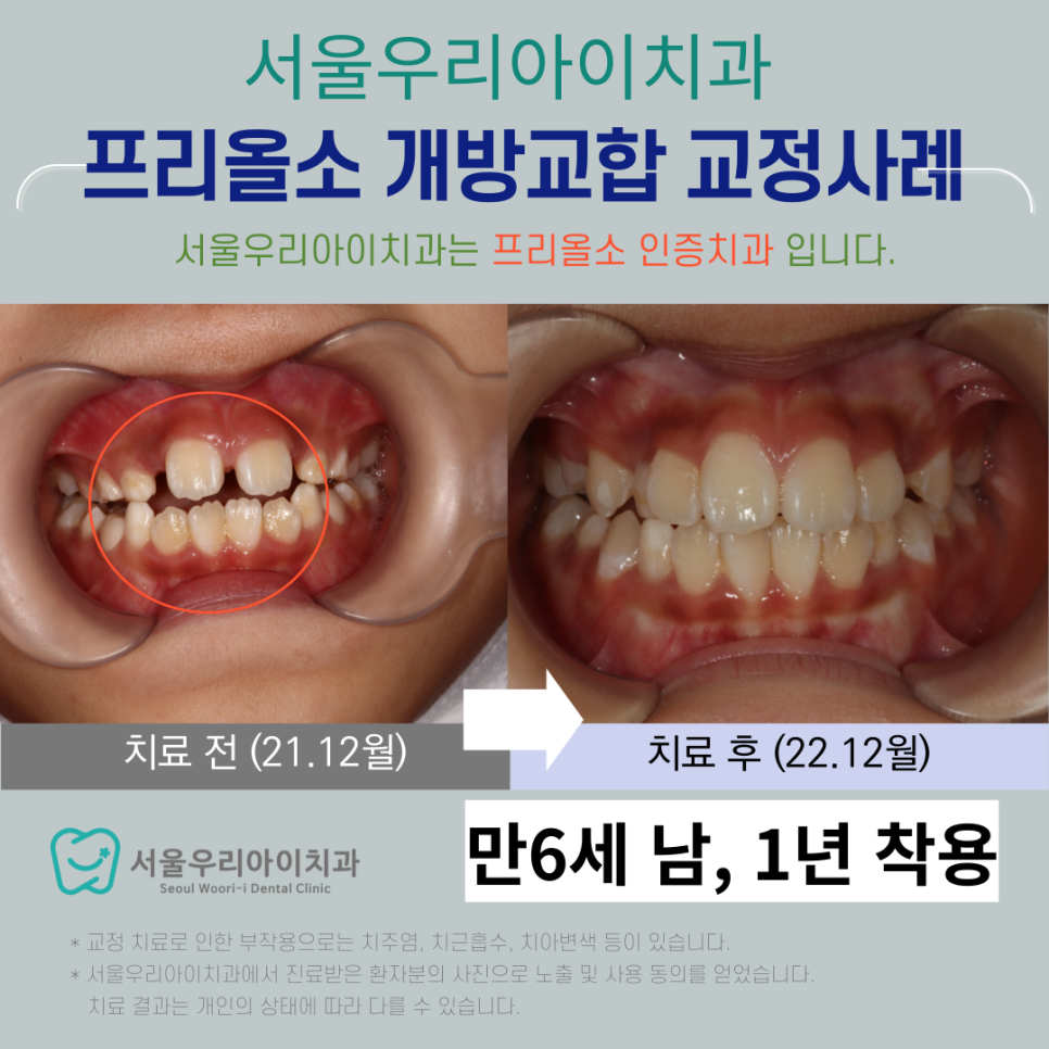 광주 개방교합 발음이 새고 입을 벌리는 습관이 있다면 확인하세요!