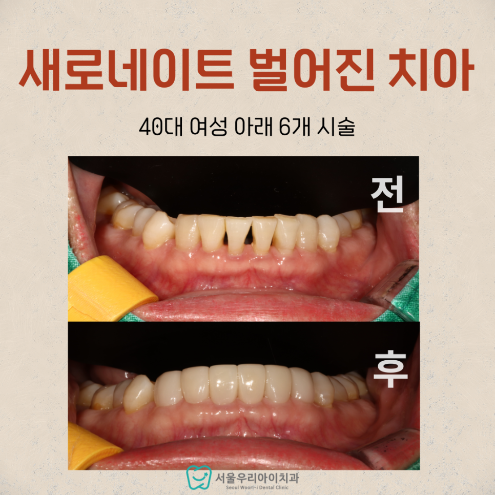 치아교정 없이 치아 사이 틈을 해결하는 방법이 있을까요?