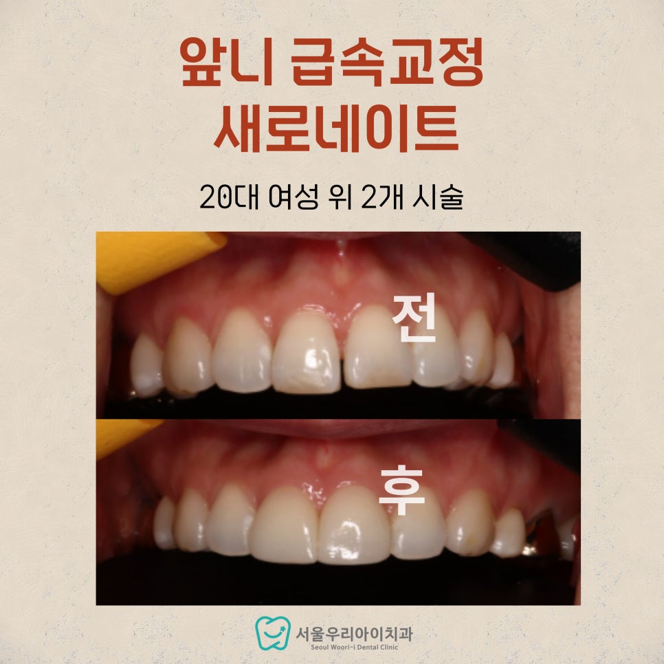 앞니 급속 교정 새로네이트 광주 라미네이트 치과에서