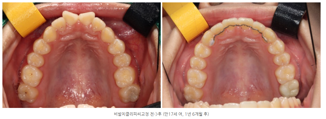 광산구교정치과 클리피씨교정 비발치로 하는 곳은 어디있나요?