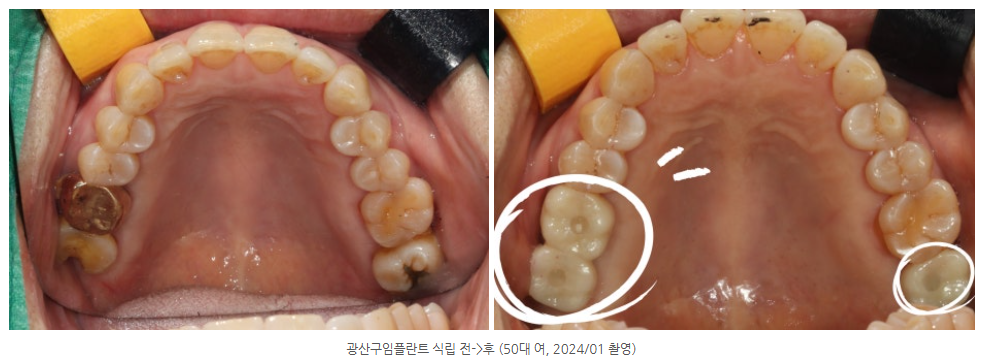 광산구 임플란트 5개를 한 번에 심을 수 있을까요?