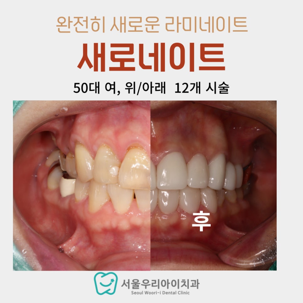 광주에서 임플란트와 라미네이트를 동시에 할 수 있는 치과가 있을까요?
