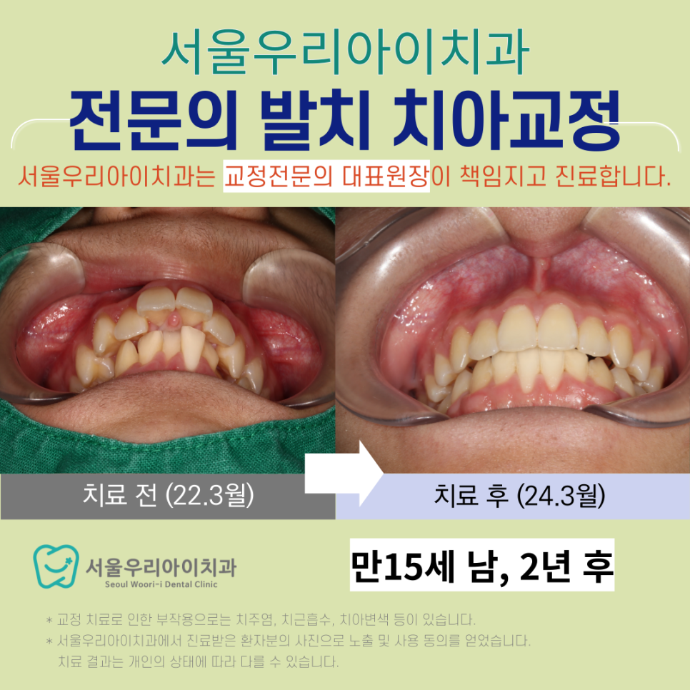 교정전문의 대표원장이 직접 책임지고 진료하는 광산구 교정치과는?