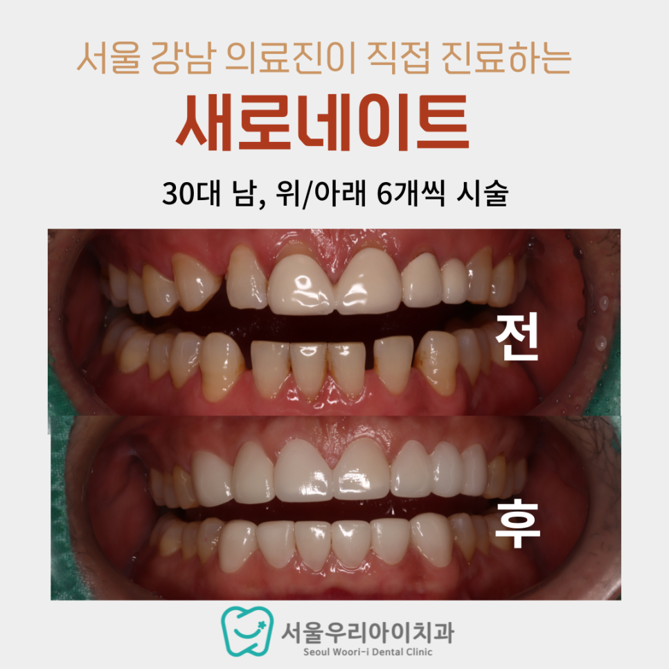 광주 남자도 라미네이트 하나요?