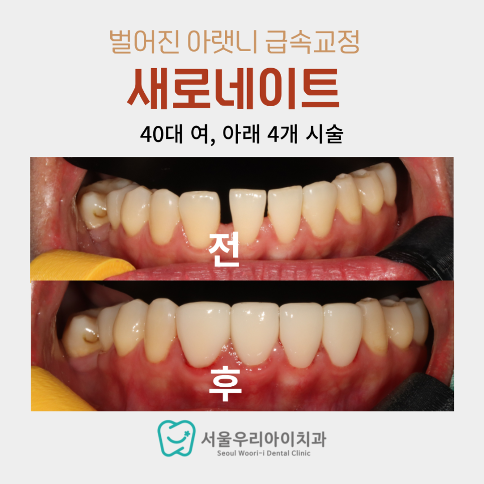 아랫니 라미네이트도 가능한가요?