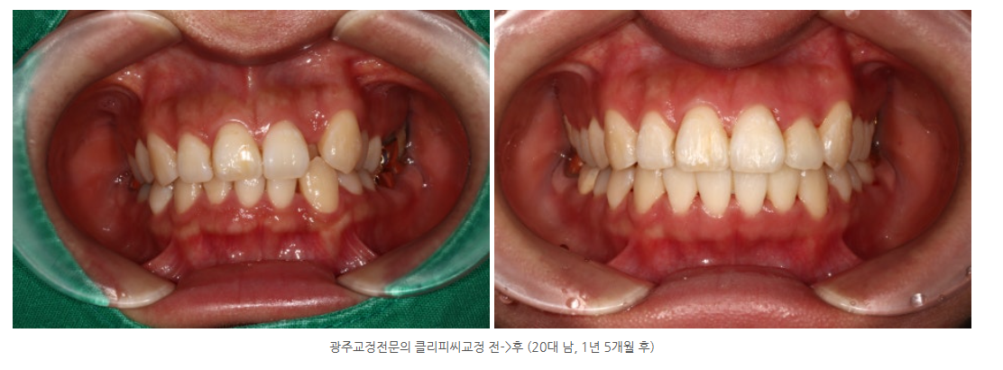 20년 이상 경력의 경험많은 교정전문의 치과 광주광역시에서