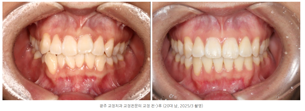 광주에서 경력이 많은 20년 경력의 교정전문의 진료는 어디서 할까요?
