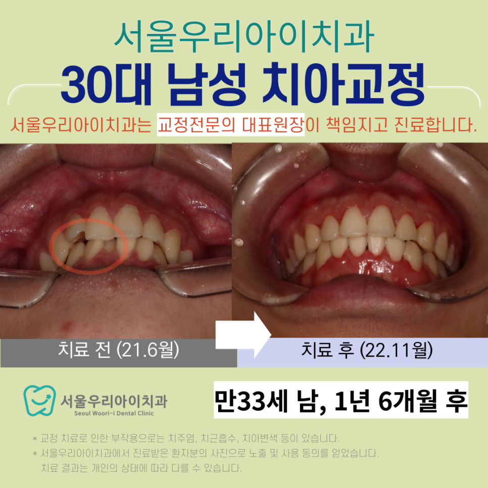 광주 비발치교정 정품 클리피씨교정은 어디서 할까요?