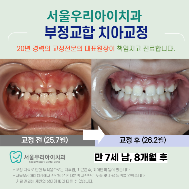 광주 부정교합 반대교합을 개선할 수 있는 프리올소 교정장치로