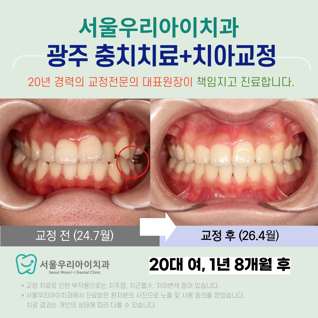 광주 성인 치아교정 분과별 전문의 진료로 충치치료부터 치아교정까...