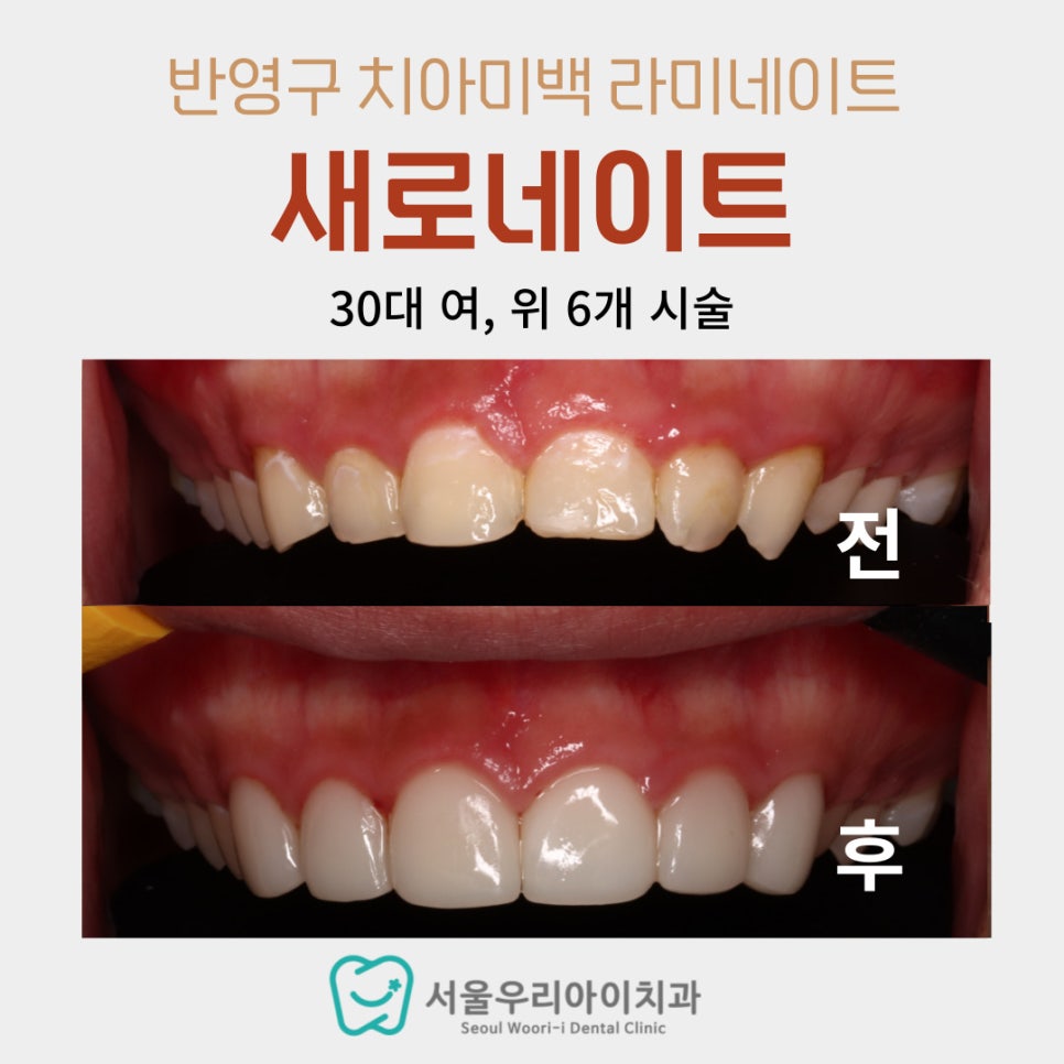 광주치아미백 광주반영구치아미백 광산구치아미백치과 있나요?