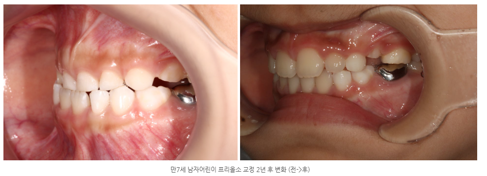 프리올소 광주어린이교정치과에서 몇 살부터 시작할 수 있나요?