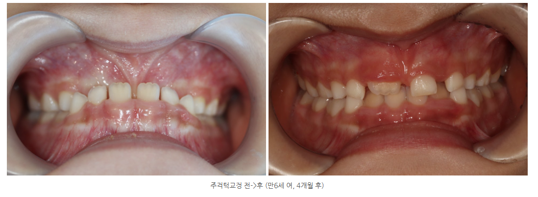 광주 주걱턱 치아교정 교정전문의가 직접 진료하는 곳에서