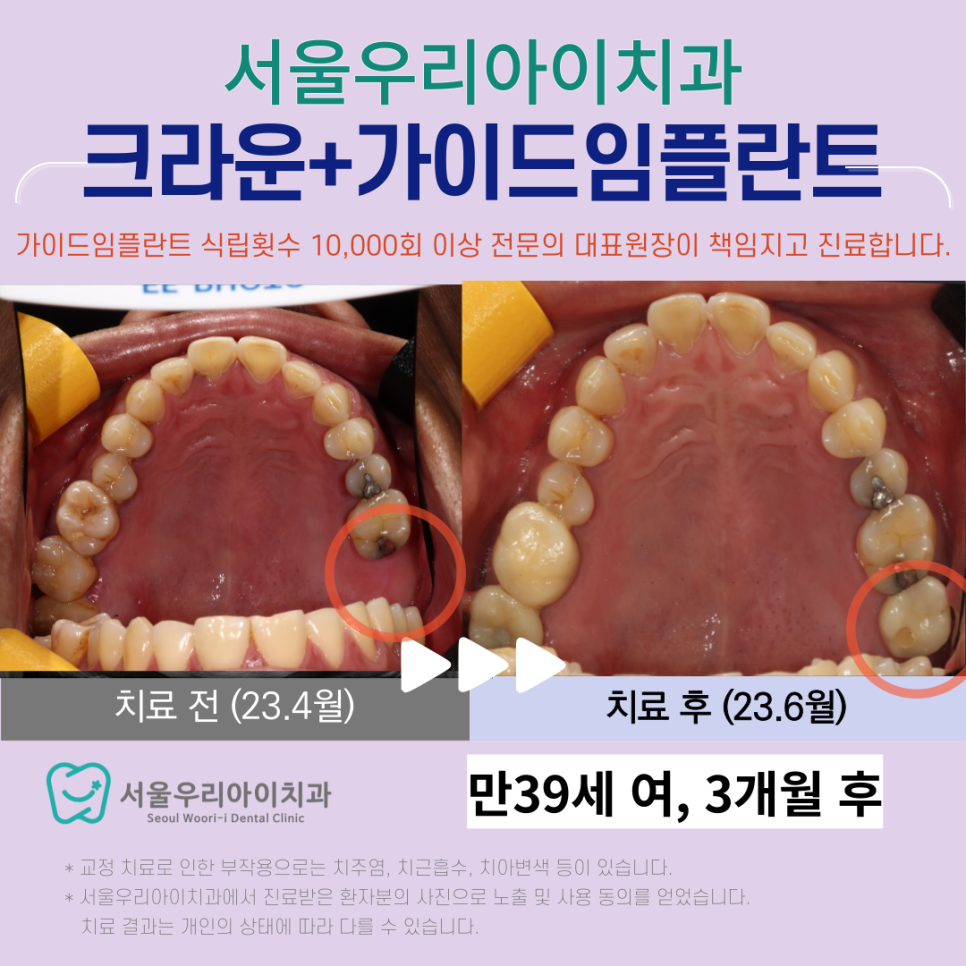 광산구 임플란트 치과에서는 크라운 치료로 최소한의 임플란트 갯수...