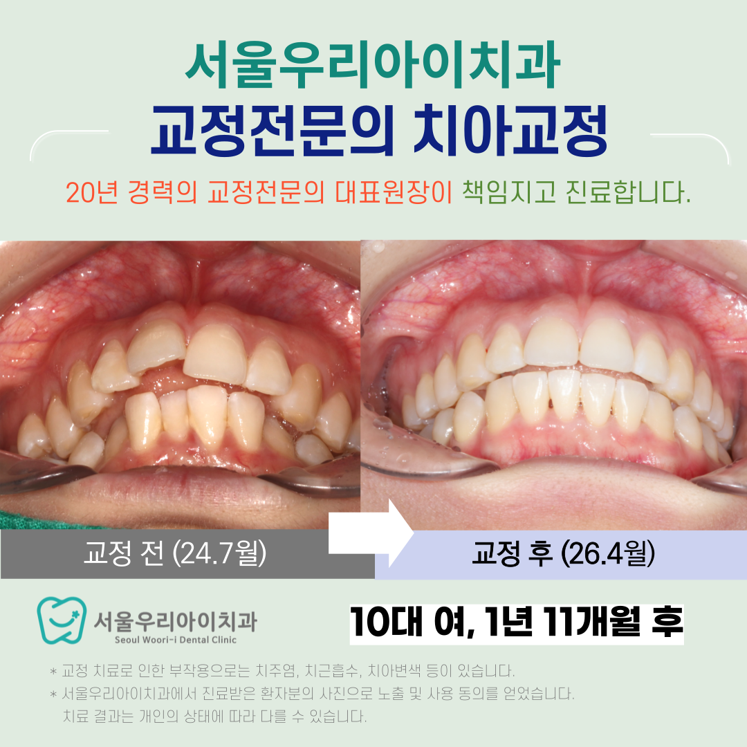 광주 교정치과 추천 믿을 수 있는 교정치과의 이유는