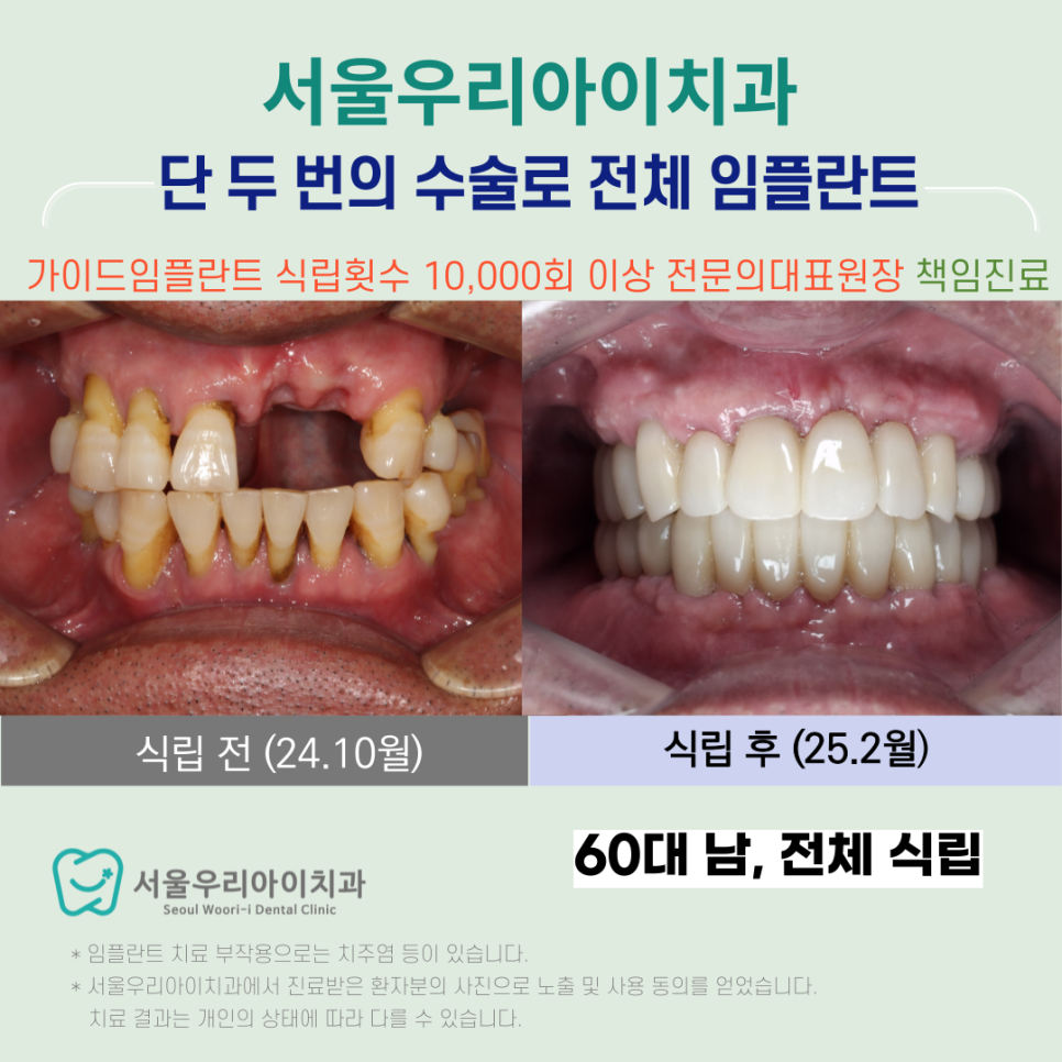 수완지구 치과에서 4개월 만에 전체 임플란트를 완성하는 방법은?