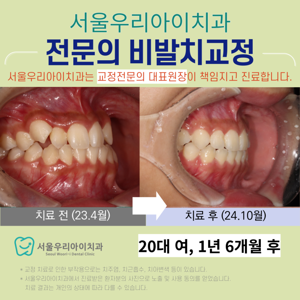 광산구 교정치과에서 부정교합과 비발치교정으로 고른 치열을 완성하...
