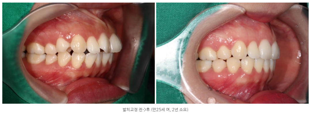 광주발치교정치과 돌출입교정 교정전문의 대표원장이 직접 진료하는 곳에서