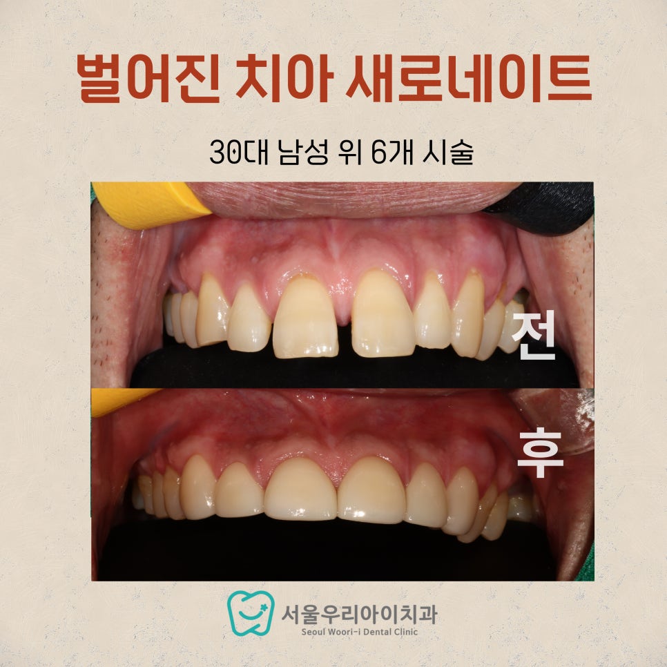 광주 최소삭제 라미네이트를 잘하는 치과에서 30대 남성 새로네이...