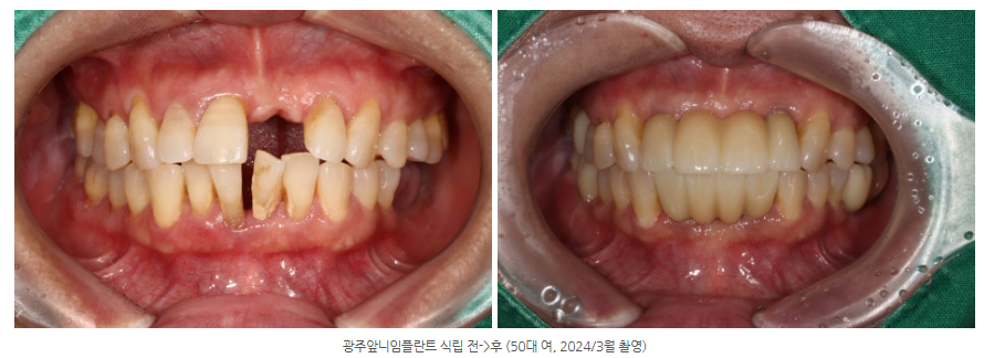 광주 광산구 수완지구에 앞니 임플란트를 정말 잘하는 치과를 찾는다면?