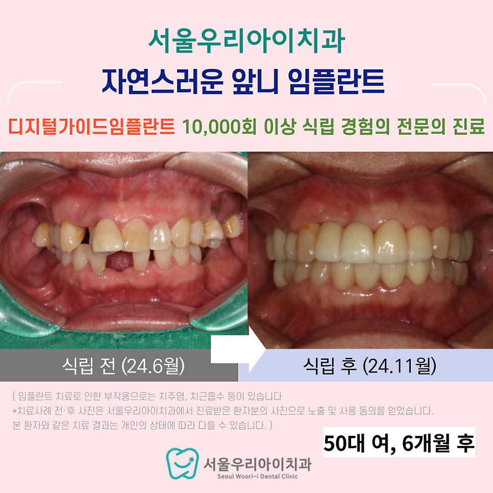 하남동 임플란트 앞니 임플란트 예쁘게 잘하는 치과에서