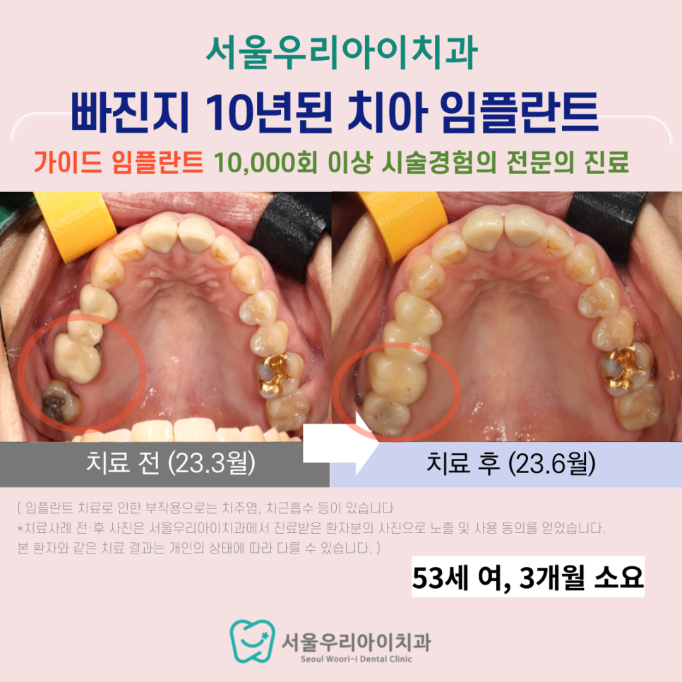 광산구 임플란트 치과에서 빠진지 10년 넘은 치아도 성공적으로...
