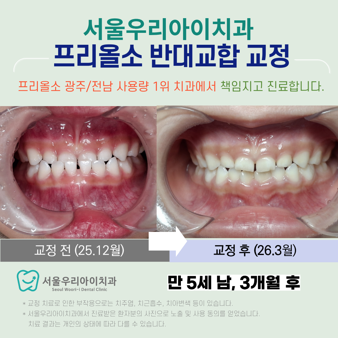 광주 소아치과 전문의 진료로 반대교합 교정부터 인 소아 룸 진료...