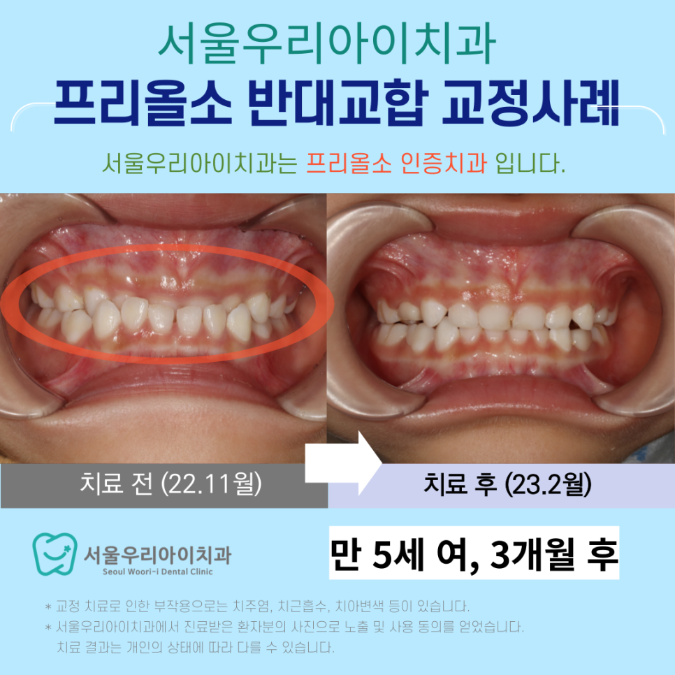 앞니가 반대로 물릴 때 어떻게 치료해야 할까요?