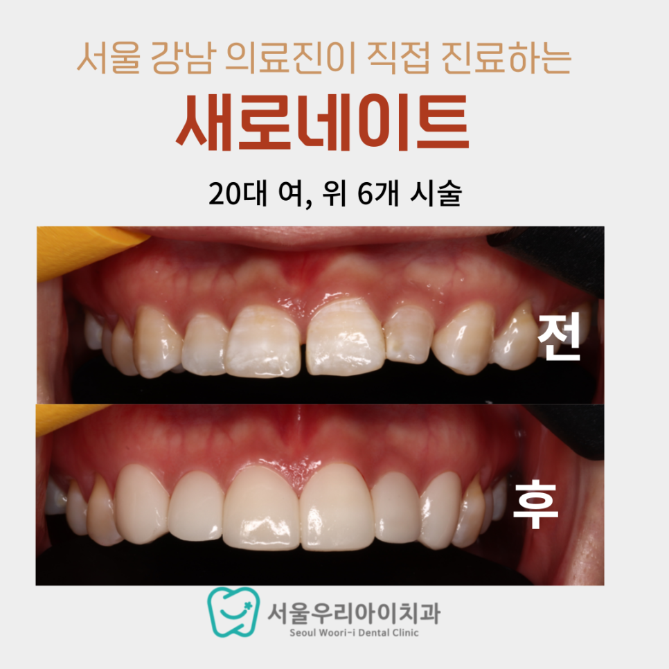 광고 아닌 대표원장이 직접 작성하는 광주 라미네이트 사례