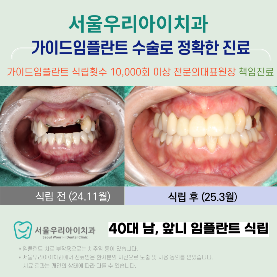 광주 앞니 임플란트 예쁘게 잘하는 치과를 찾고 있다면?