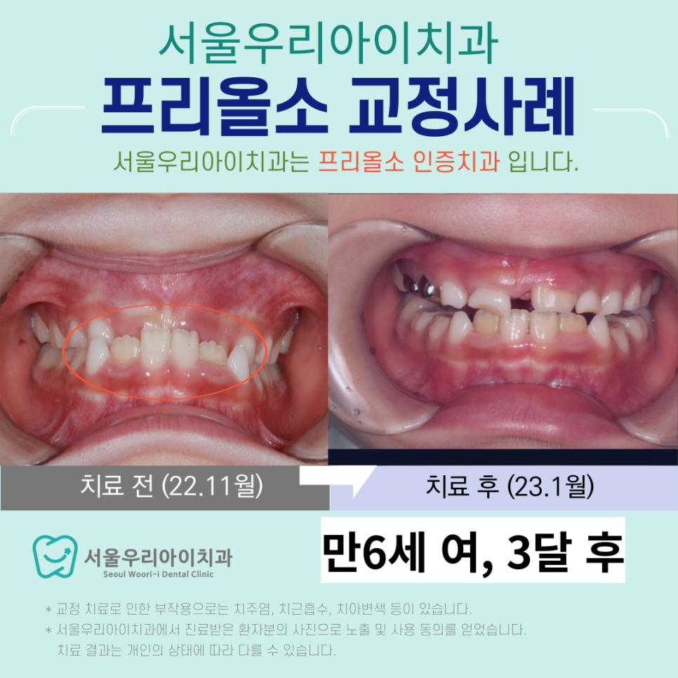 프리올소 교정 나이는 몇 살 부터 가능한가요?
