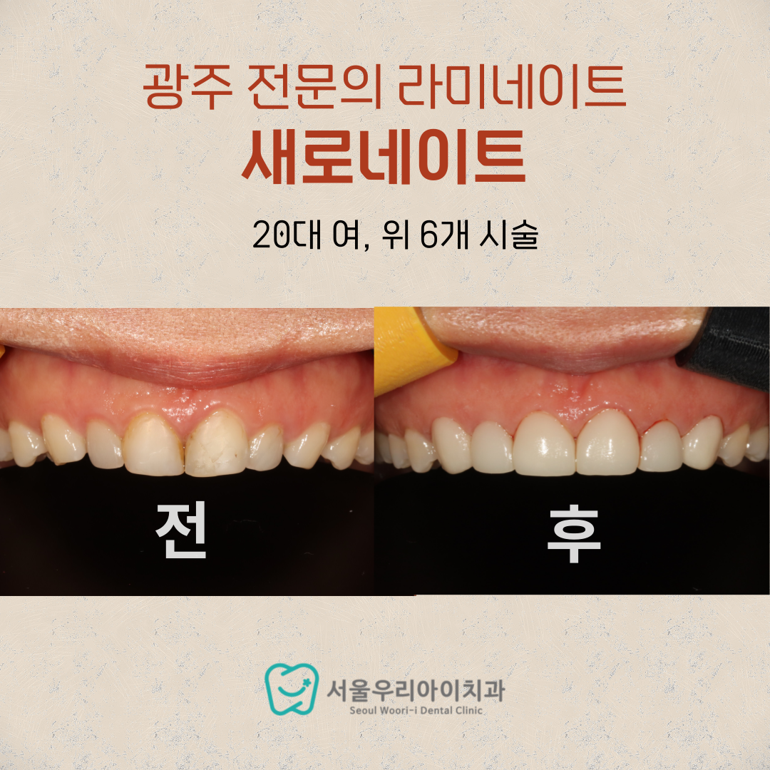 광주 무삭제라미네이트 추천하는 이유는