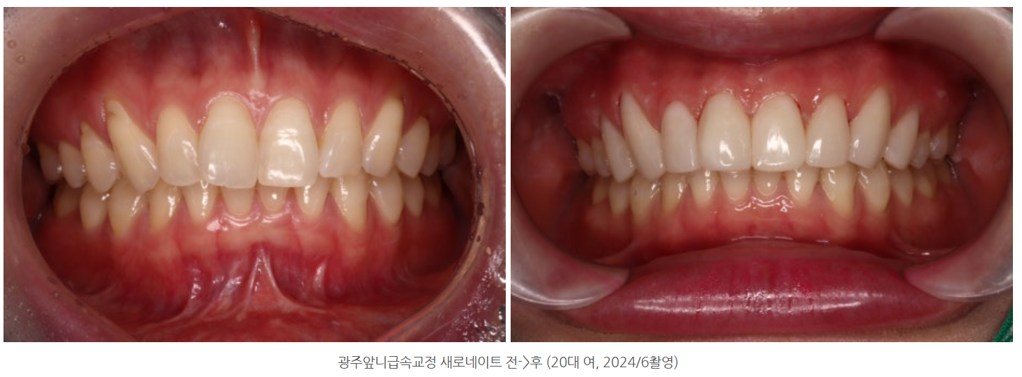 광주광역시에서 20대 앞니 급속 치아교정 가능한 곳은?