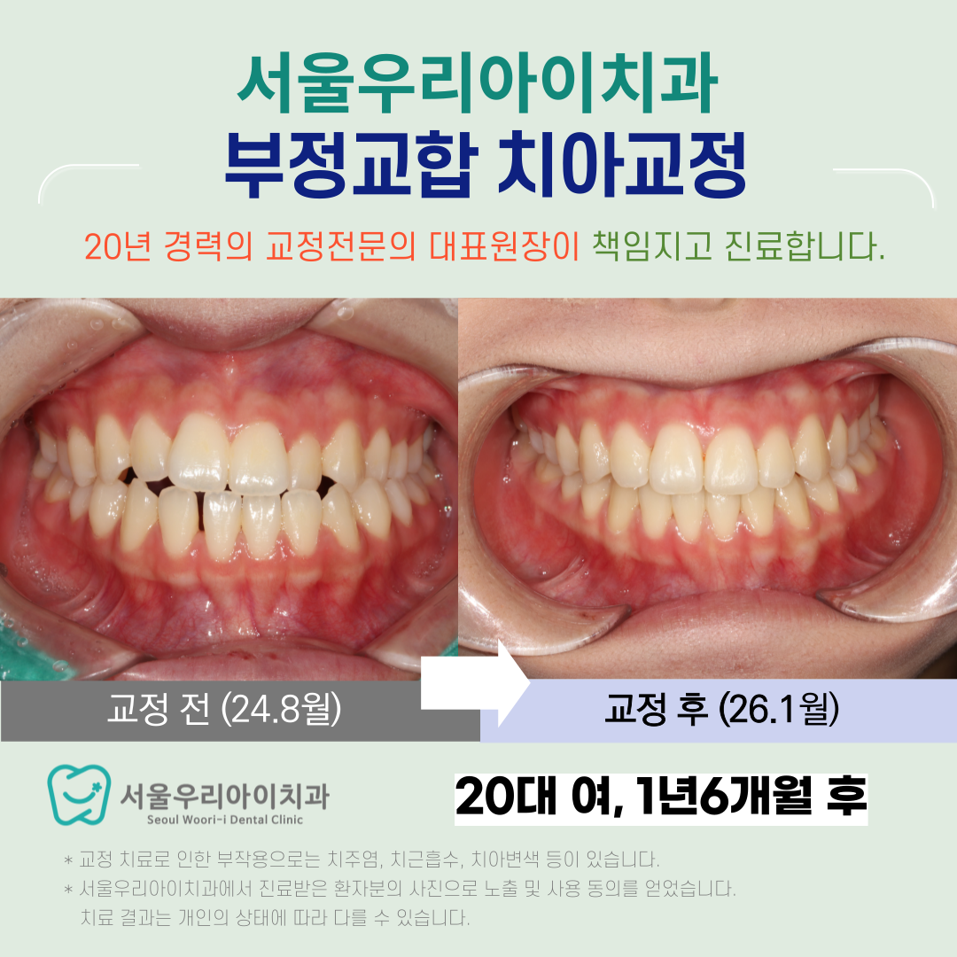 광주치아교정 교정전문의가 중간에 바뀌지 않는지 경력을 확인해야하...