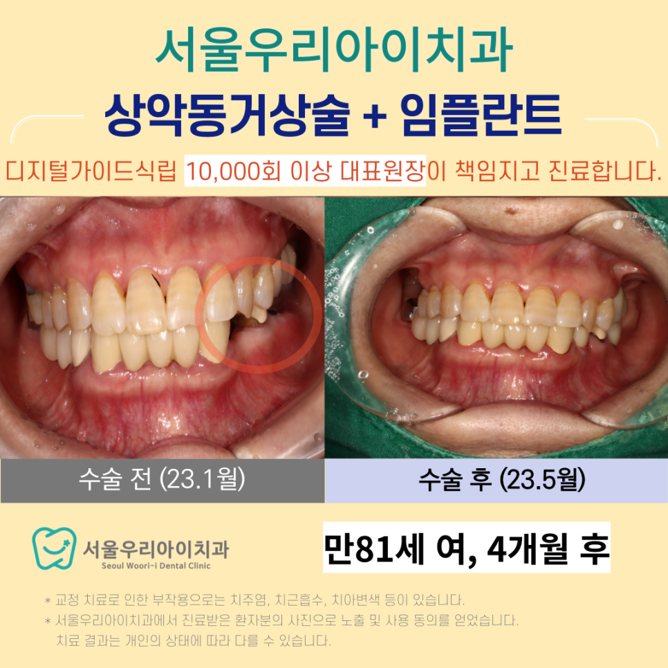 광주에서 80살 넘는 환자도 임플란트 수술이 가능한 치과가 있을까요?