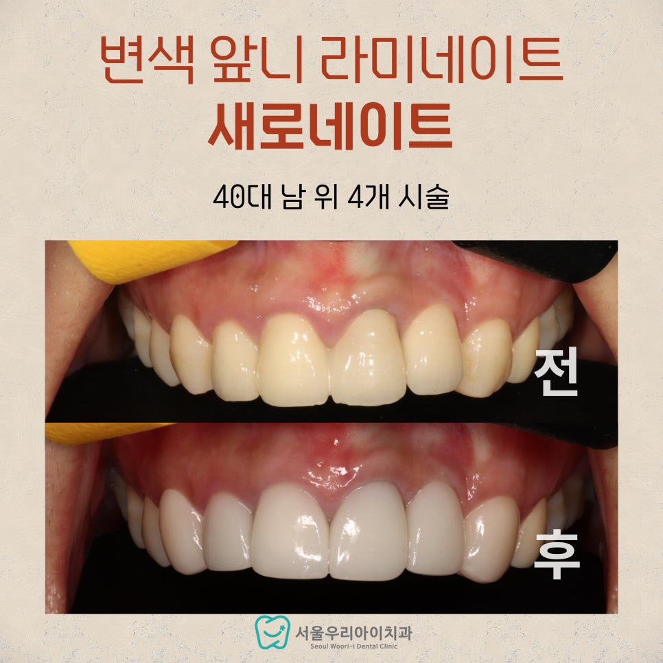 앞니가 부딪혀서 깨졌거나 앞니 신경치료로 인해 까맣게 변색되었다...