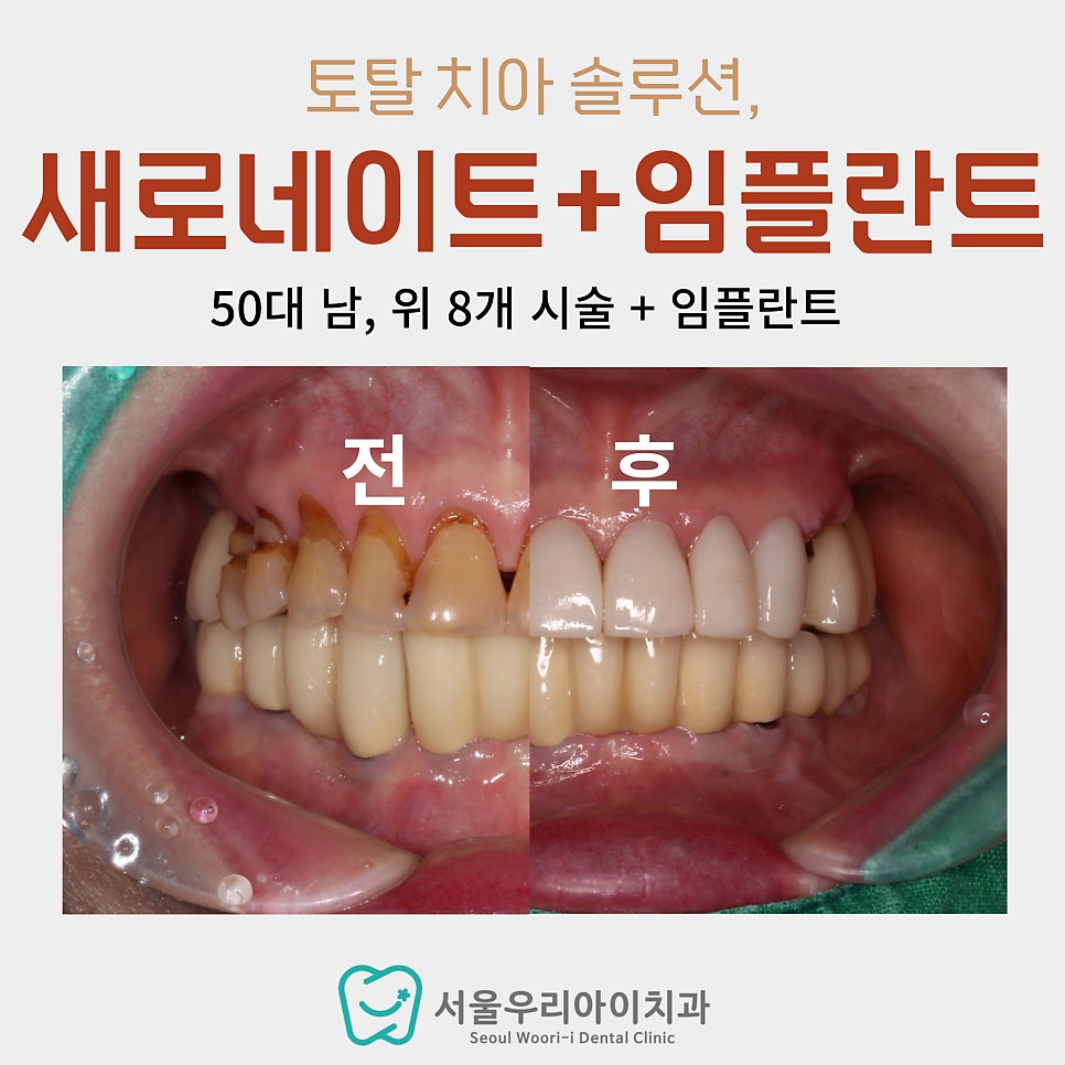 임플란트와 라미네이트 동시에 진행하여 광주 라미네이트 치과에서...