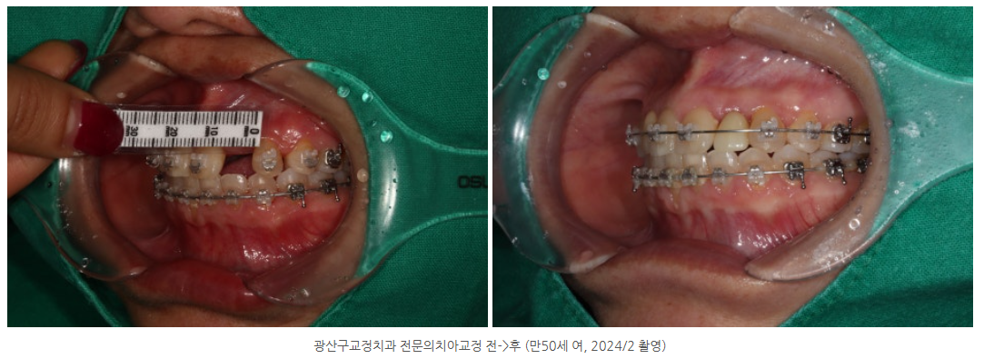 치아사이 빈공간에는 전문의치아교정+전문의디지털가이드임플란트 동시...