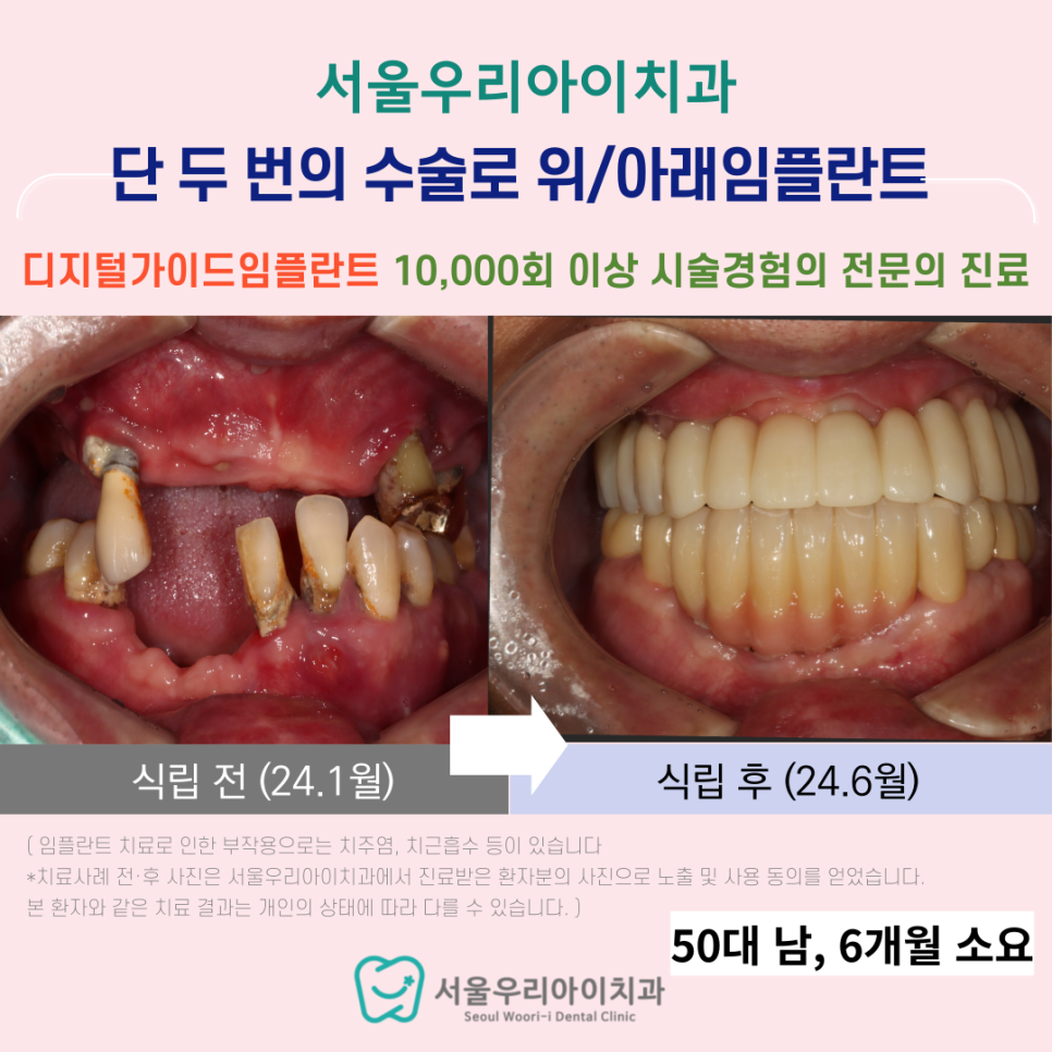 광산구 임플란트 치과에서 단 두 번의 수술만으로 가능한 이것 진료는?