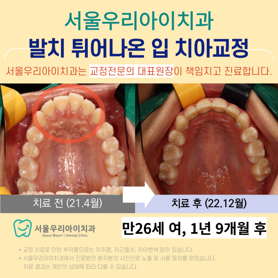 튀어나온 입 광주교정치과 전문의 발치교정으로 해겷가능합니다