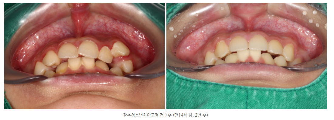 영구치결손 치아교정 찾고 계시다면 꼭 확인하세요!