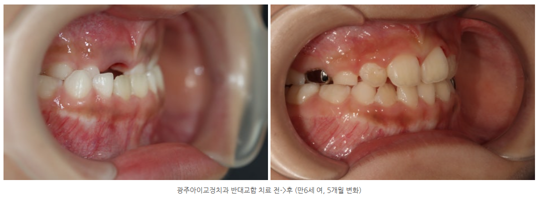 광주 아이교정치과 반대교합 치료 방법은?