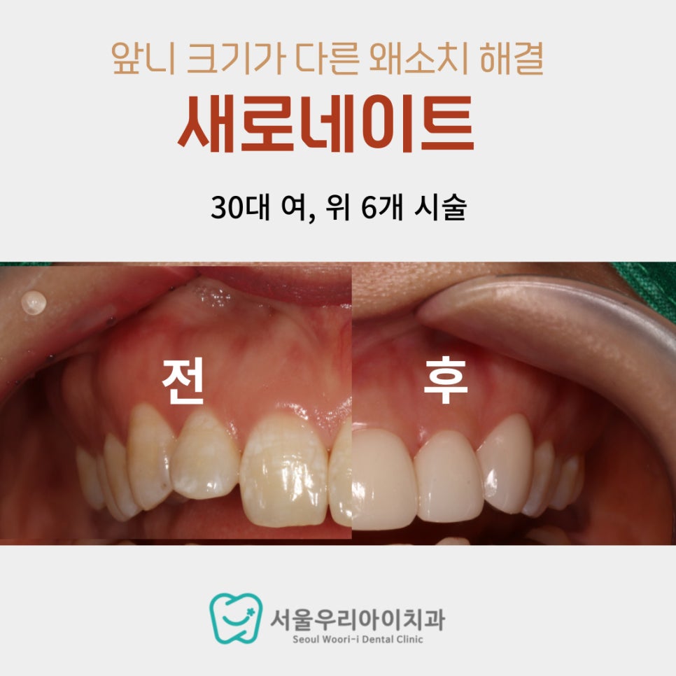 앞니가 컴플렉스라서 활짝 못 웃는 사람이 있다면 필수로 읽어보세요!
