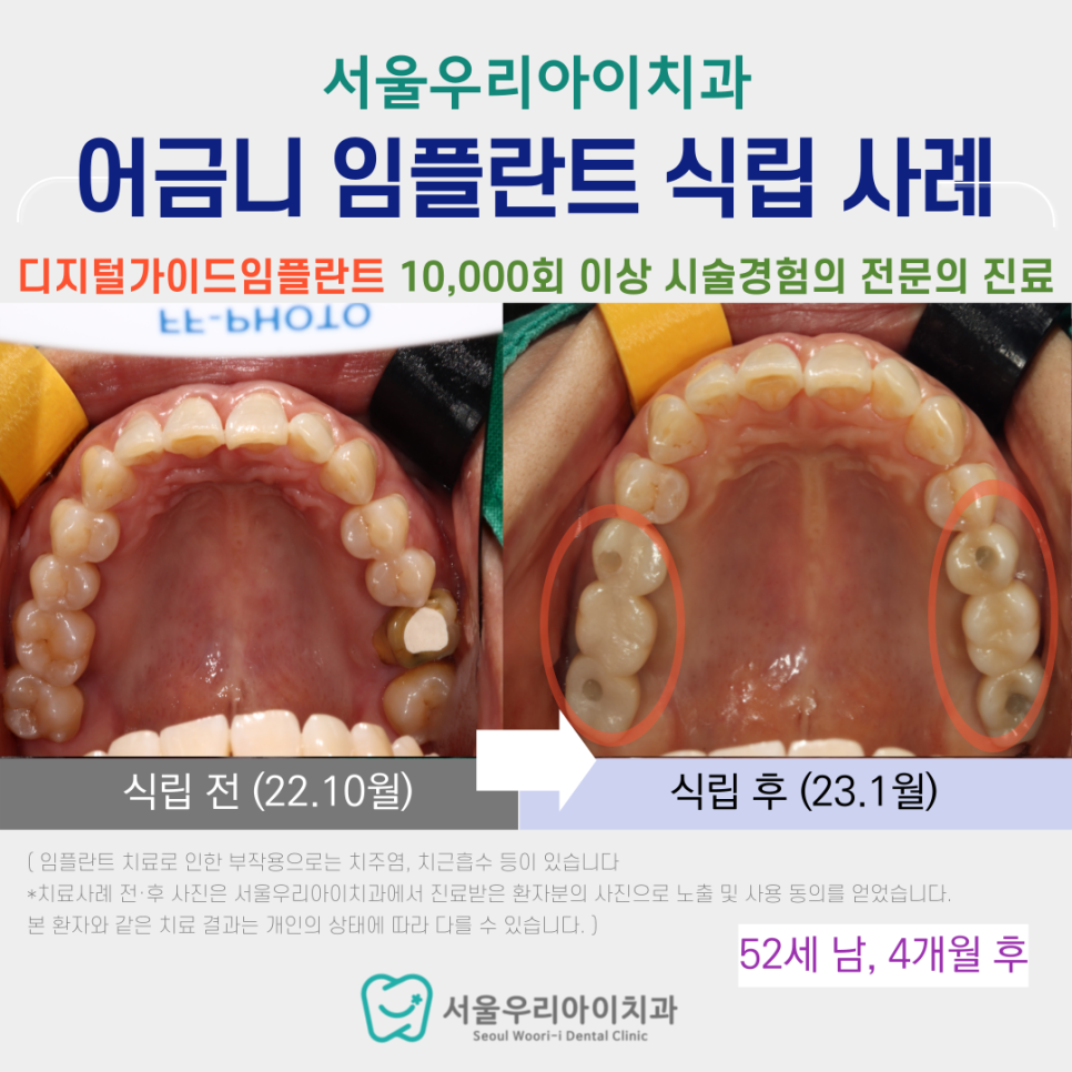 광산구 수완지구 임플란트치과에서 디지털 가이드 임플란트를 고집하...