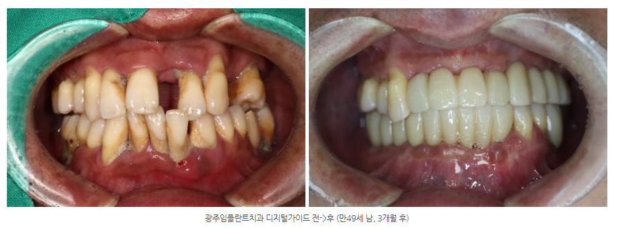 광주 위 아래 임플란트 전체 임플란트 잘하는 치과는?