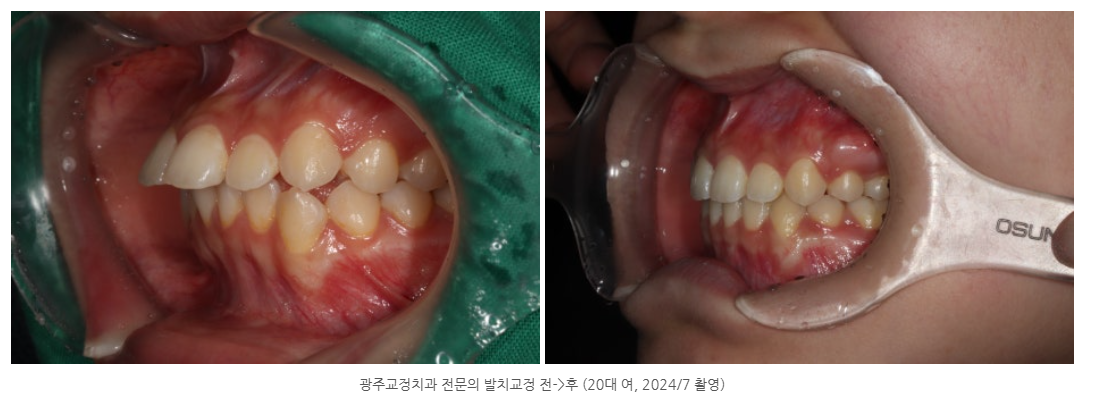 광주 돌출입 교정치과를 찾는다면 이것 꼭 확인하세요!